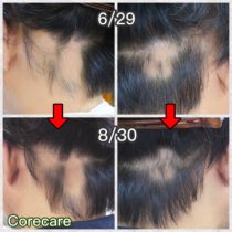 薄毛改善実績（円形脱毛症）
